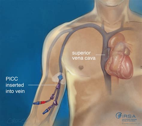 Peripherally Inserted Central Catheter PICC Insertion