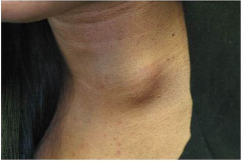 Late Onset Of Cryptococcal Cervical Lymphadenitis Following Immune