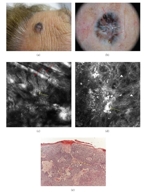 Forehead Of A 75 Year Old Woman A Bluish Ulcerated Nodule A The