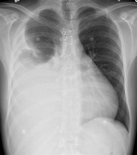 The Chest X Ray In Cardiovascular Disease Wikidoc