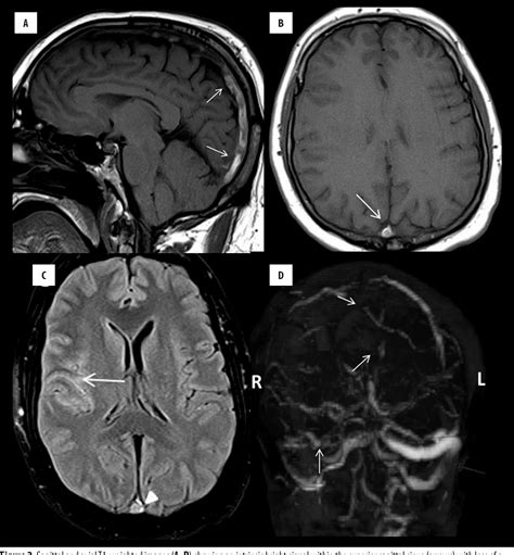 Figure 2 From Diffuse Subarachnoid Hemorrhage Secondary To Cerebral