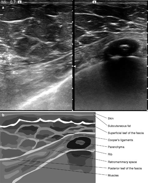 Ultrasound Of The Normal Breast Springerlink