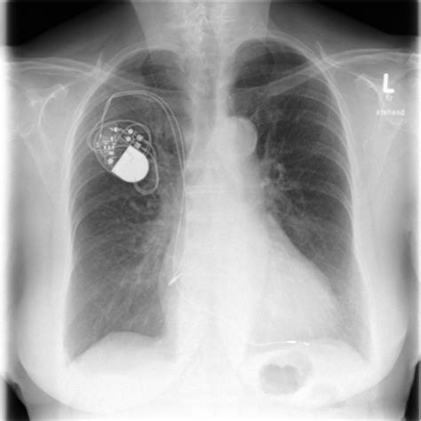 Published on september 29, 2014. Chest X-ray after pacemaker implantation. | Open-i