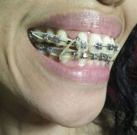 Braces Girlswithbraces Metalbraces Elastics Dental Braces Metal Braces Orthodontics Braces