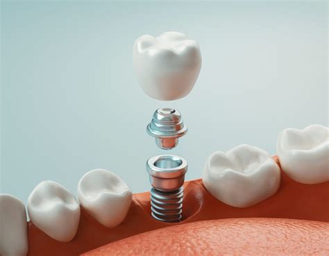 Implantes Dentales ¿qué Son Para Qué Sirven Y Cómo Funcionan