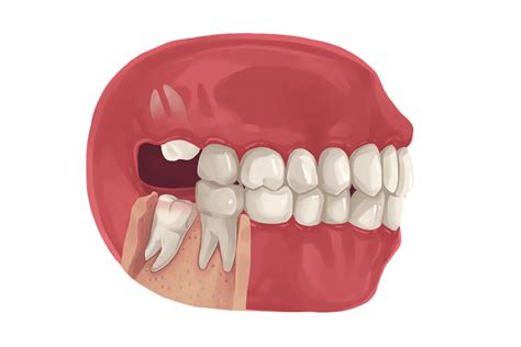 what you need to know about wisdom tooth removal