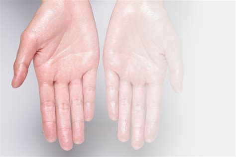 Hyperhidrosis Sweaty Hands Treatment Cape Coral Fl Excessive
