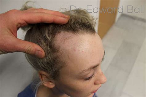 Diva S Hair Loss Story Makes Headline News All Over The Internet The Maitland Clinic