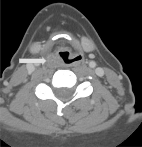 Axial Image From Contrast Enhanced Ct Scan Of The Neck Demonstrates