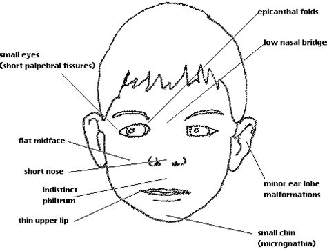 Widened nasal (including round face, frontal bossing, antimongoloid slant of the eyes, epicanthal folds, large low set. Flat Nasal Bridge And Epicanthal Folds : Recognize Iem In ...