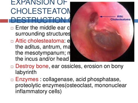 Cholesteatoma And Chronic Suppurative Otitis Media