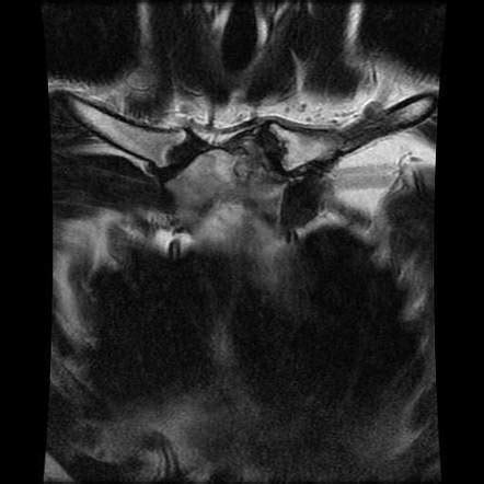 Septic Arthritis Of Sternoclavicular Joint Radiology Case Radiopaedia Org