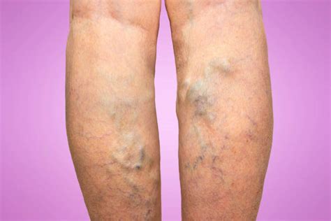 Varicose Vein Stock Photos Pictures And Royalty Free Images Istock