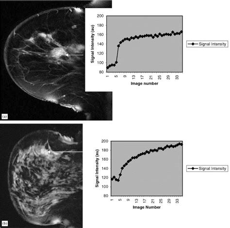 Differentiation Of Benign From Malignant Breast Disease Associated With