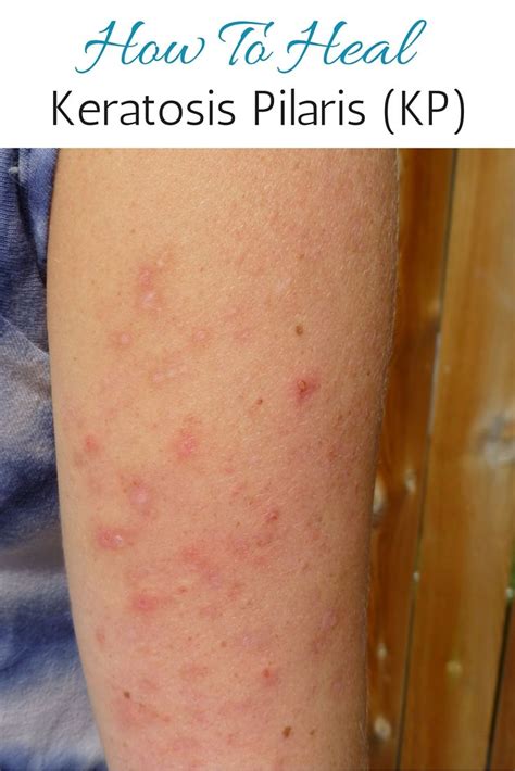 Keratosis Pilaris Also Commonly Referred To As Kp Or Chicken Skin Put