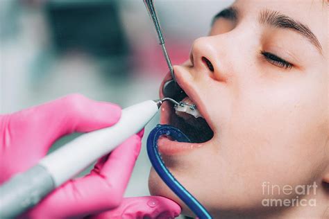 Orthodontist Cleaning Girl S Braces Photograph By Microgen Images Science Photo Library Fine