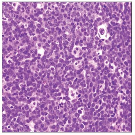 Primary Diffuse Large B Cell Lymphoma Of The Cns Basicmedical Key