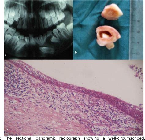 Figure 1 From Inflammatory Dentigerous Cyst Associated With Mandibular