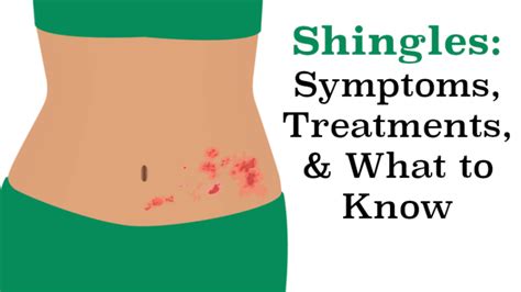 Shingles Symptoms Treatments And What To Know Womenworking