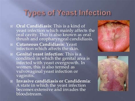 Yeast Infection Probiotic