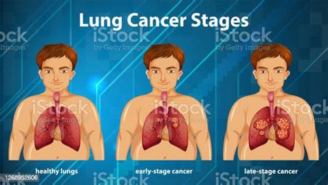 informative illustration of lung cancer stages stock illustration download image now lung