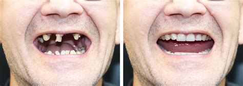 Meth Effects Teeth
