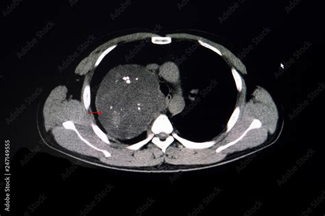 Ct Scan Of A Chest Showing Anterior Mediastinal Tumor Stock Photo