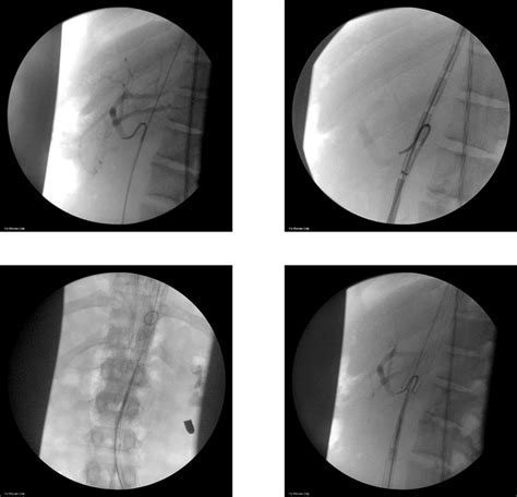 Endovascular Stent Graft Repair Of An Abdominal Gunshot With Liver And