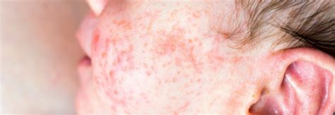 Eczema Herpeticum What You Need To Know