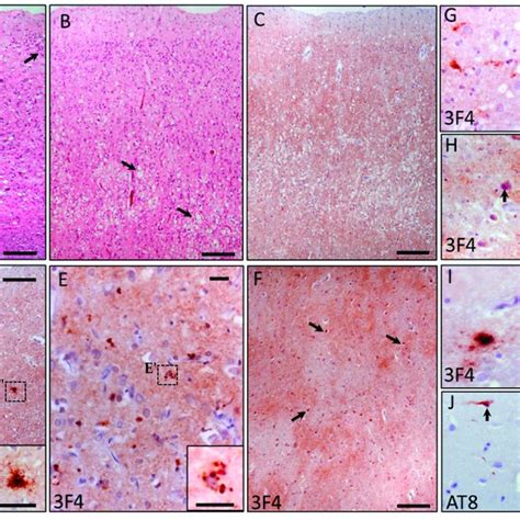 Neuropathological Findings A Frontal Cortex Hande Prominent