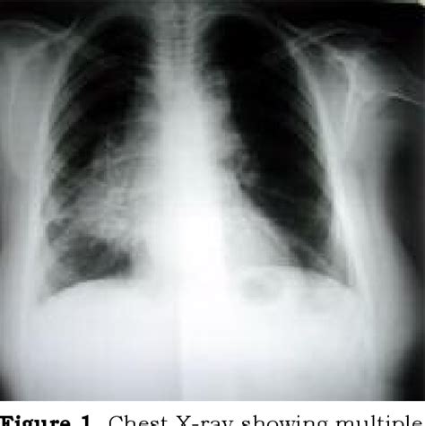 Figure 1 From Mediastinal Lymph Node Tuberculosis In An Adult A Case
