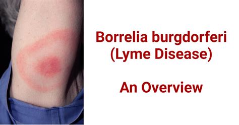 Borrelia Burgdorferi Lyme Disease An Overview