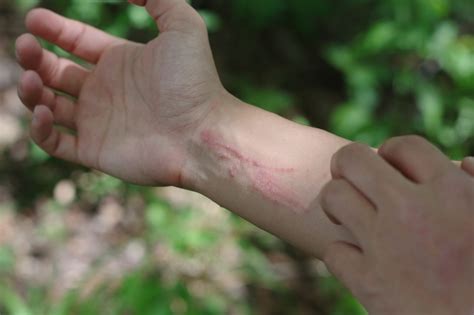 How Long Before Poison Ivy Rash Appears