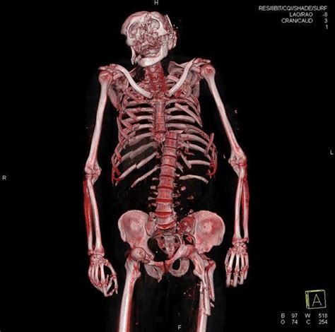 Tecnicos Radiologos La Autopsia Virtual Aplicada A La Radiología