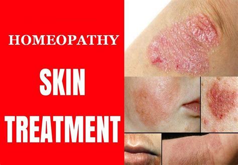 Kesula Clinic Permanent Treatment For Fungal Infection 16632 Hot Sex Picture
