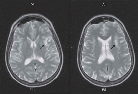Neuroimaging Findings Axial T2 Weighted Mri Scans Revealing An Acute