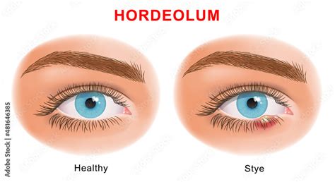 Eye Stye Sty Problem Before And After Treatment External Hordeolum