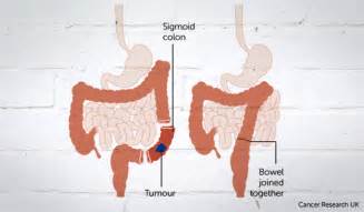 Bowel Cancer Diagram