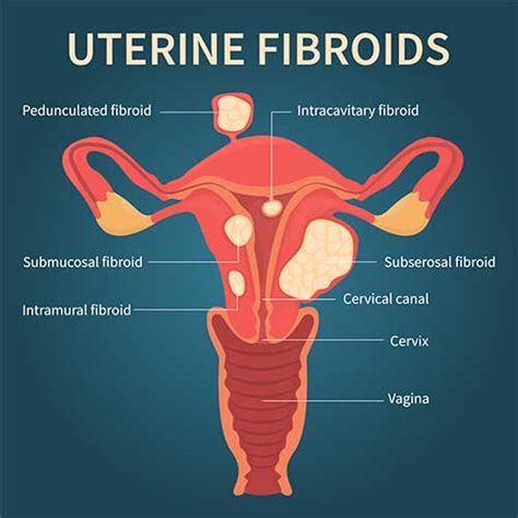 Intramural Fibroids What Are They Symptoms Causes Diagnosis And
