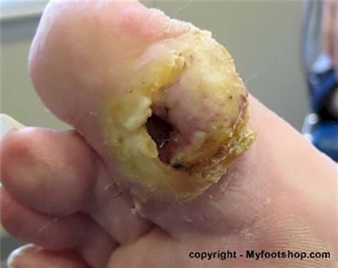 Diabetic Wound Care Causes And Treatment Options