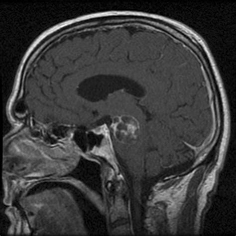 Imaging And Clinical Features Of An Intra Axial Brain Stem Schwannoma