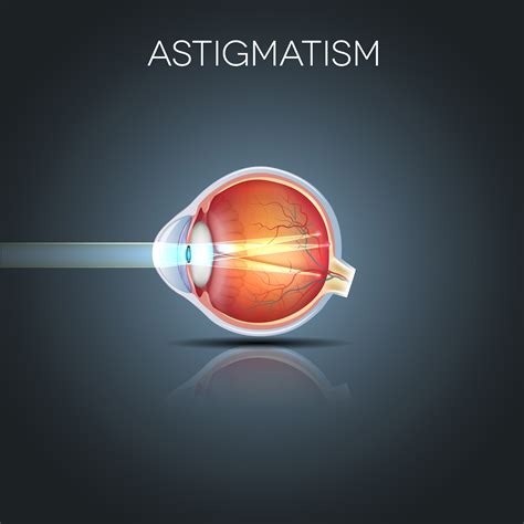 Ten Things To Know About Astigmatism Better Vision Guide