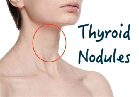 All Natural Remedies For Thyroid Cystic Nodules —