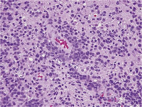 Diffuse Large B Cell Lymphoma Variants An Update Pathology