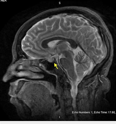 Mri Brain In Sagittal Section Showing Abnormal Enlargement Of The