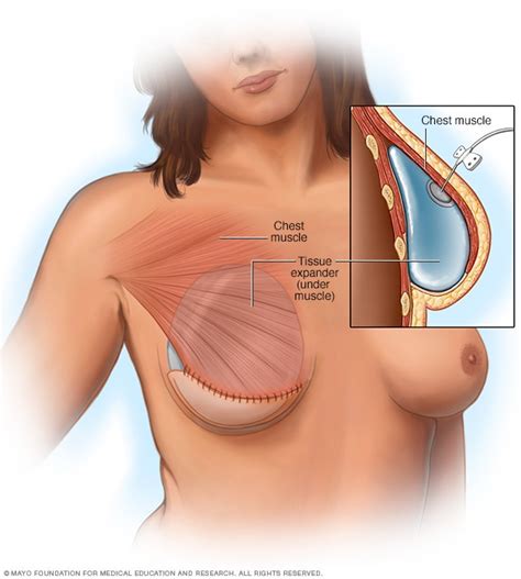 Tuesday, december 22, 2020 21:10. Breast reconstruction with implants - Mayo Clinic