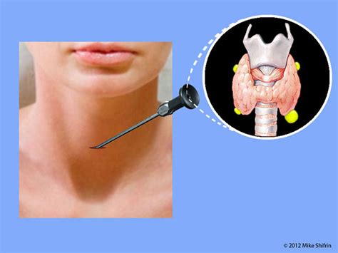 Minimally Invasive Parathyroidectomy