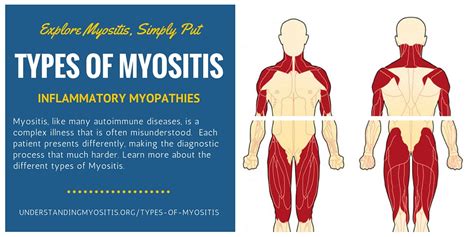 Myositis Leandra Barkley