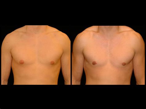 Gynecomastia Before And After Premier Plastic Surgery