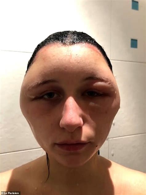 Womans Head Puffs Up After Allergic Reaction To Hair Dye And Becomes